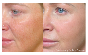 BBL HEROic Laser Treatment