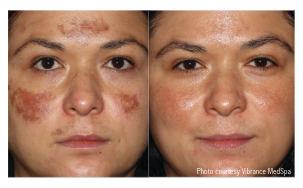 HALO Laser Treatment