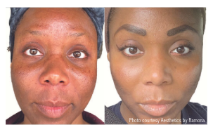 MOXI Laser Treatment