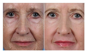 Profractional