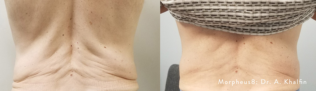 Morpheus8 Microneedling Before and After