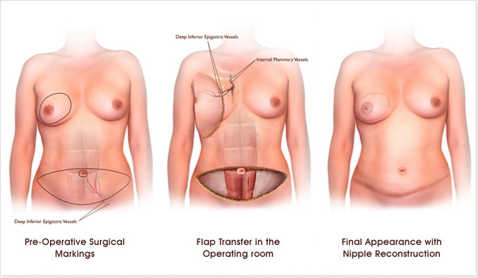 DIEP Flap Breast Reconstruction Surgery NJ