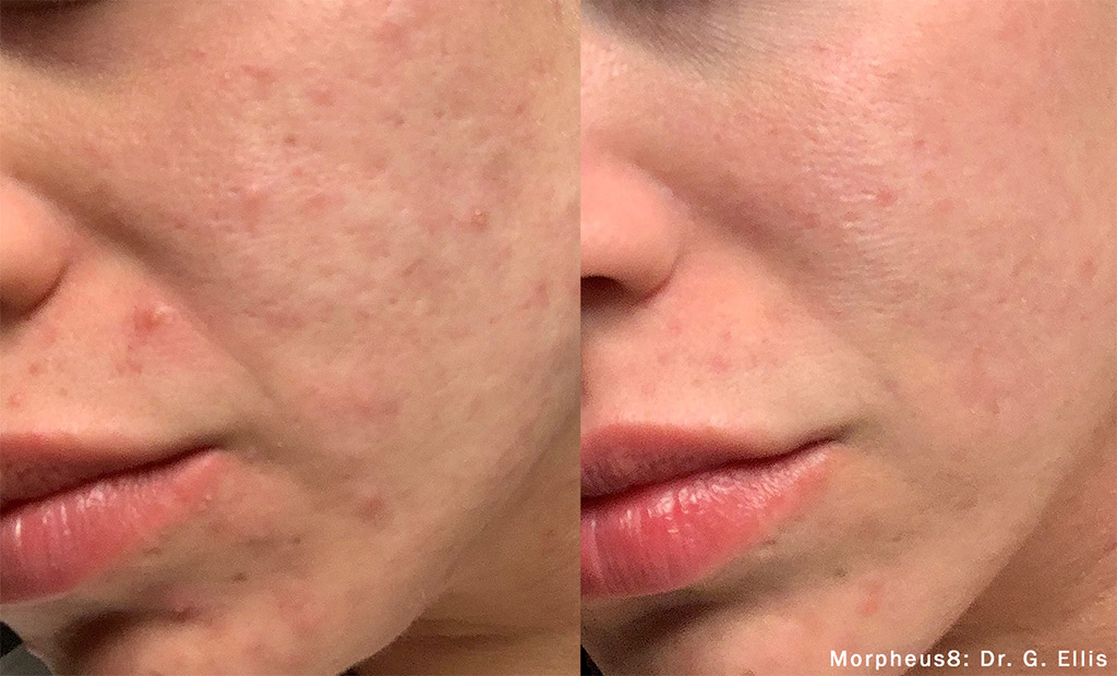 Morpheus8 Microneedling Before and After