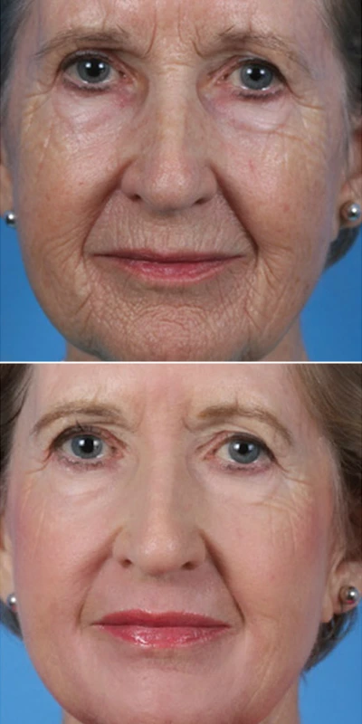 before and after image of wrinkle repair using laser skin resurfacing treatment