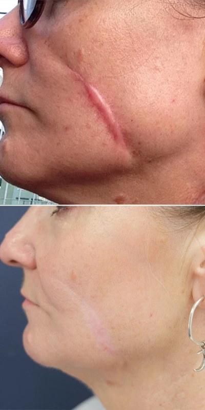 before and after image of scar repair using laser skin resurfacing treatments