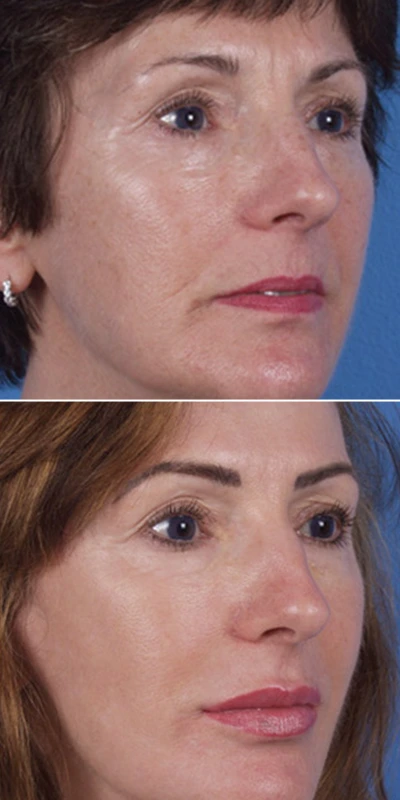 before and after image of increased skin elasticity with laser skin resurfacing treatments