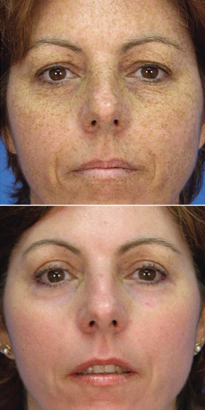 before and after image of sun damage repair using laser skin resurfacing treatment
