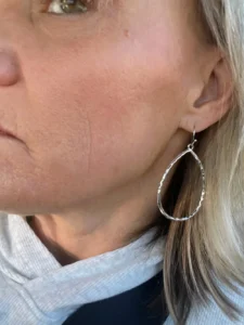 14 day post LF cheek zoomed in BBL