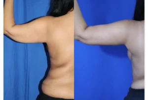 Brachioplasty