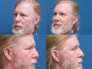 Upper / Lower Blepharoplsty with Brow Lift