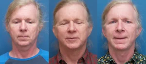 Face / Neck Lift, Genioplasty