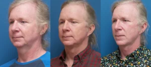 Face / Neck Lift, Genioplasty