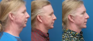 Face / Neck Lift, Genioplasty