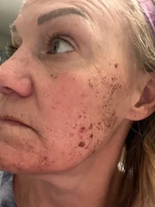 4 DAY POST BBL HEROIC LFT CHEEK