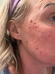 4 DAY POST BBL HEROIC RT CHEEK