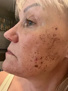 5 DAY POST BBL HEROIC LFT CHEEK