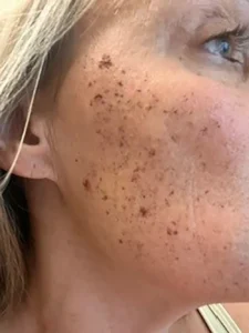 5 DAY POST BBL HEROIC RT CHEEK