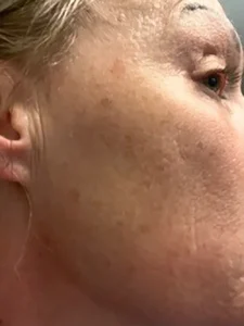 5 HRS POST BBL HEROIC