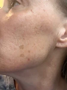 5 HRS POST BBL HEROIC LFT CHEEK