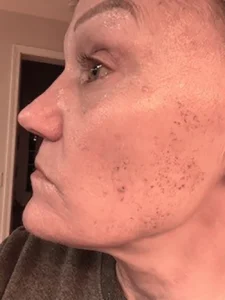 9 DAY POST BBL HEROIC LFT CHEEK