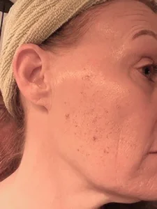 9 DAY POST BBL HEROIC LFT CHEEK