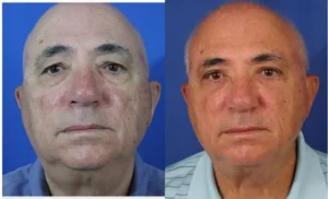 Upper / Lower Bleharoplasty