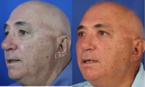 Upper / Lower Bleharoplasty