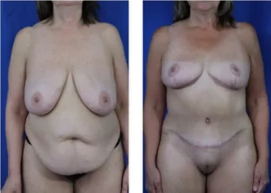 Tummy Tuck