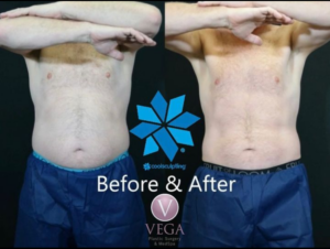 Coolsculpting for men before and after