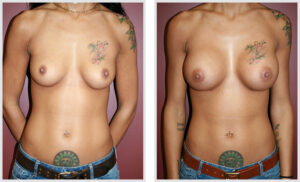 Breast Augmentation (Front)