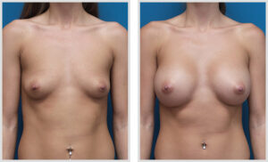 Breast Augmentation (Front)