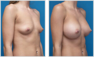 Breast Augmentation (Oblique)