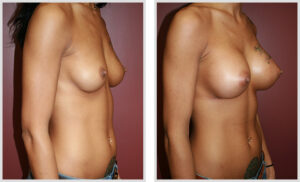 Breast Augmentation (Oblique)