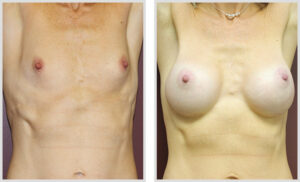 Breast Augmentation (Front)