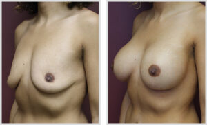 Breast Augmentation (Oblique)
