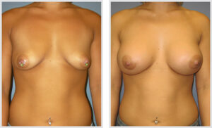 Breast Augmentation (Front)