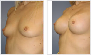 Breast Augmentation (Oblique)