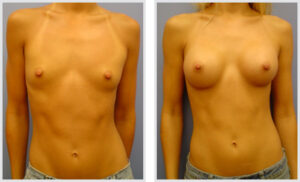 Breast Augmentation