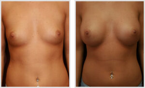 Breast Augmentation (Front)
