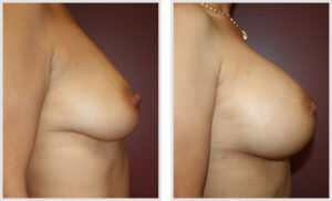 Breast Augmentation