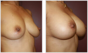 Breast Augmentation