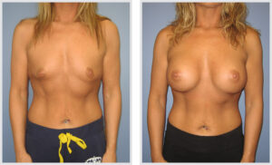 Breast Augmentation (Front)