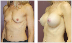 Breast Augmentation (Oblique)