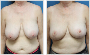 Breast Reduction (Front)