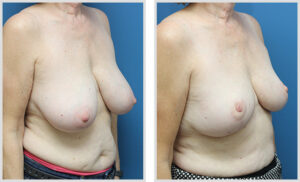 Breast Reduction (Oblique)