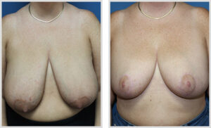 Breast Reduction (Front)