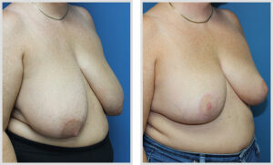Breast Reduction (Oblique)