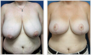 Breast Reduction (Front)