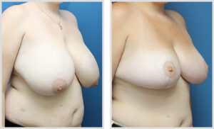 Breast Reduction (Oblique)