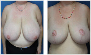 Breast Reduction & Free Nipple Graft (Front)